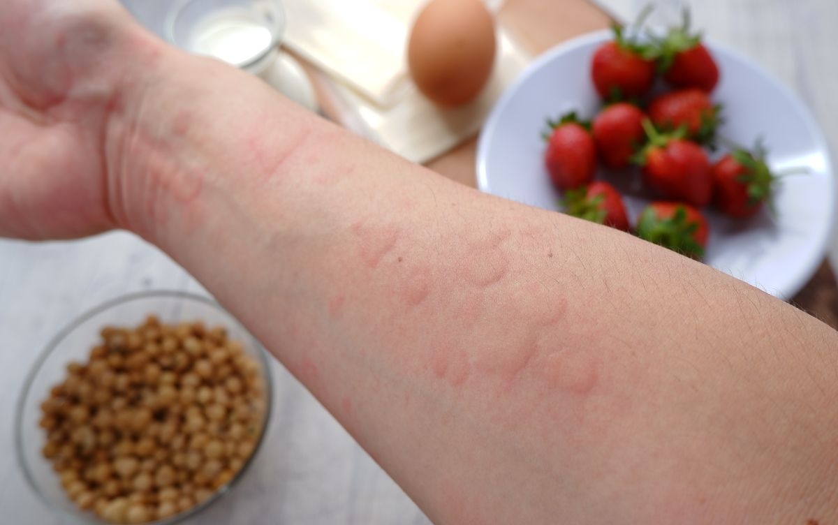 Alergie la ouă: simptome, complicații și tratament