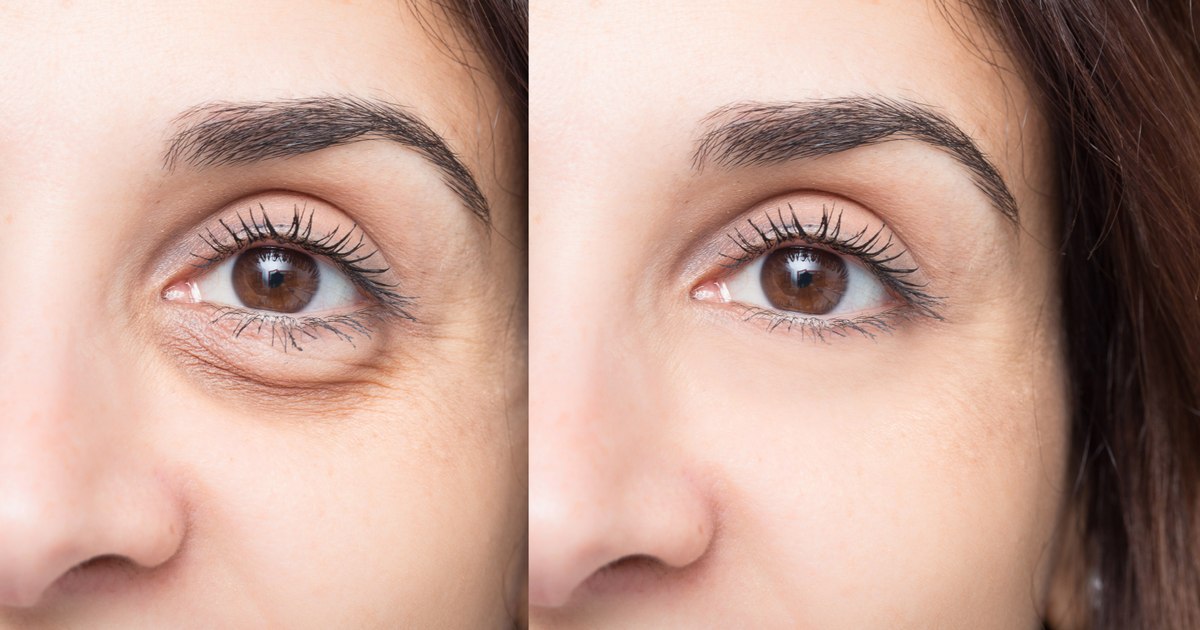 Dacă te trezești cu ochii umflați dimineața, iată adevăratul motiv și ce spune un dermatolog că trebuie să faci Dacă te trezești cu ochii umflați dimineața, iată adevăratul motiv și ce spune un dermatolog că trebuie să faci