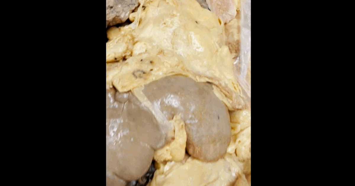 Cum atacă grăsimea viscerală „ascunsă” organele interne: videoclipul viral care șochează internetul. Pericol și pentru persoanele slabe