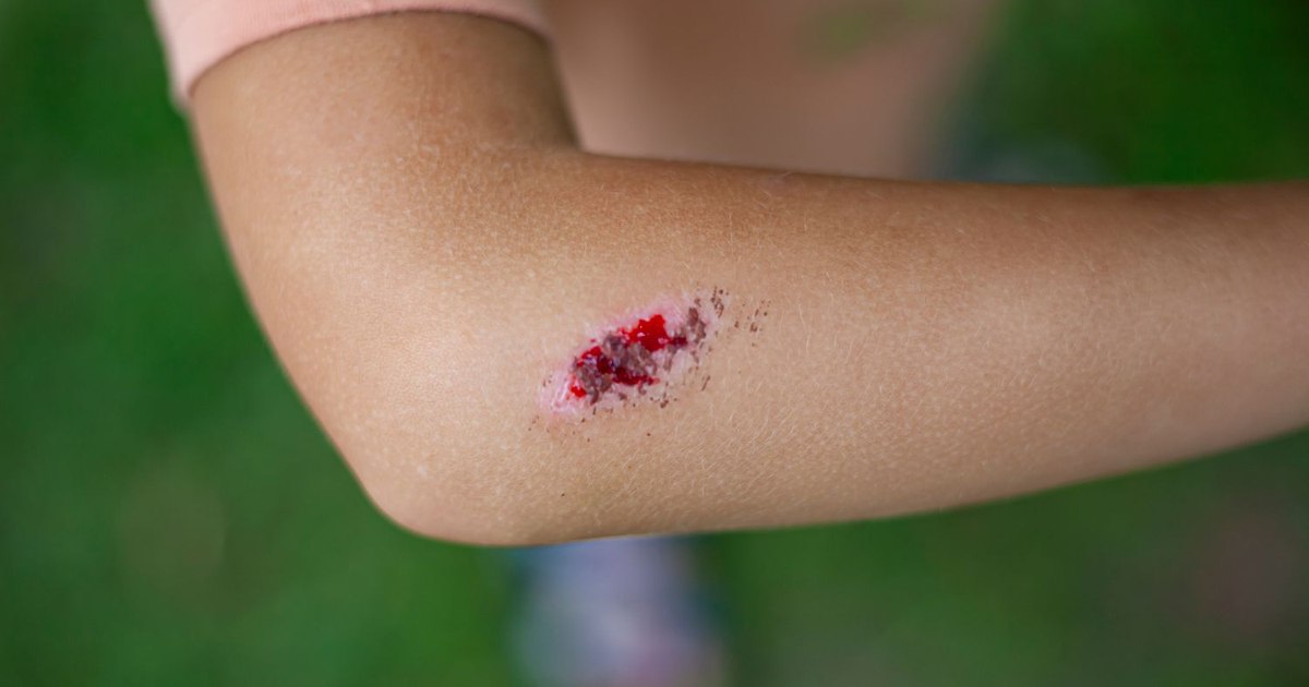 Boala infecțioasă gravă, cu mortalitate ridicată dacă nu este tratată rapid și corect. Sporii care o cauzează pot supraviețui ani de zile Boala infecțioasă gravă, cu mortalitate ridicată dacă nu este tratată rapid și corect. Sporii care o cauzează pot supraviețui ani de zile