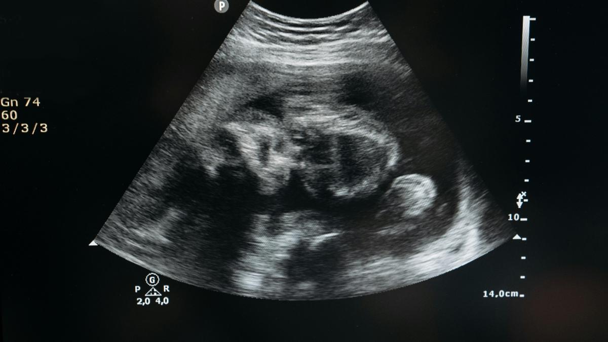 Ce este un lithopedion sau „bebelușul de piatră”? O raritate medicală care fascinează lumea Ce este un lithopedion sau „bebelușul de piatră”? O raritate medicală care fascinează lumea