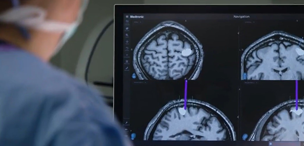 Un cip implantat în creier i-a redat vocea. Povestea unui american care a primit o nouă şansă la viaţă Un cip implantat în creier i-a redat vocea. Povestea unui american care a primit o nouă şansă la viaţă