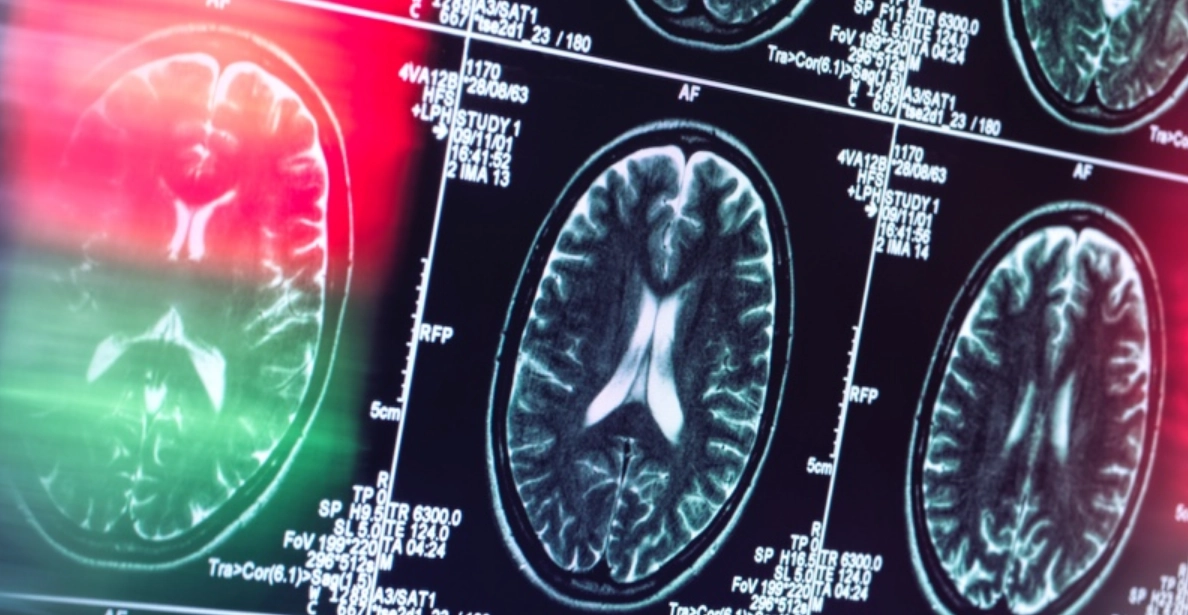 Institutul de Psihiatrie ‘Socola’ introduce un tratament unic în România pentru Alzheimer